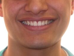 The photo teeth after