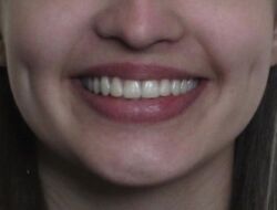 The photo teeth after