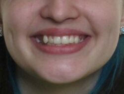 The photo teeth before