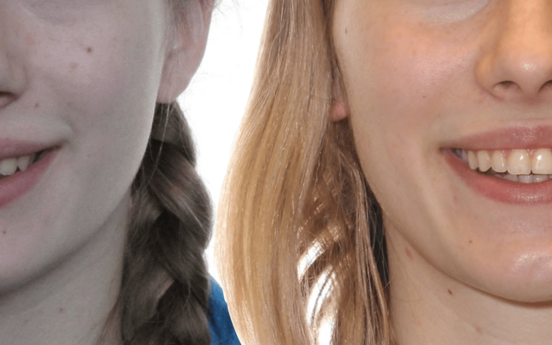 Case Study 16 – Narrow Smiles