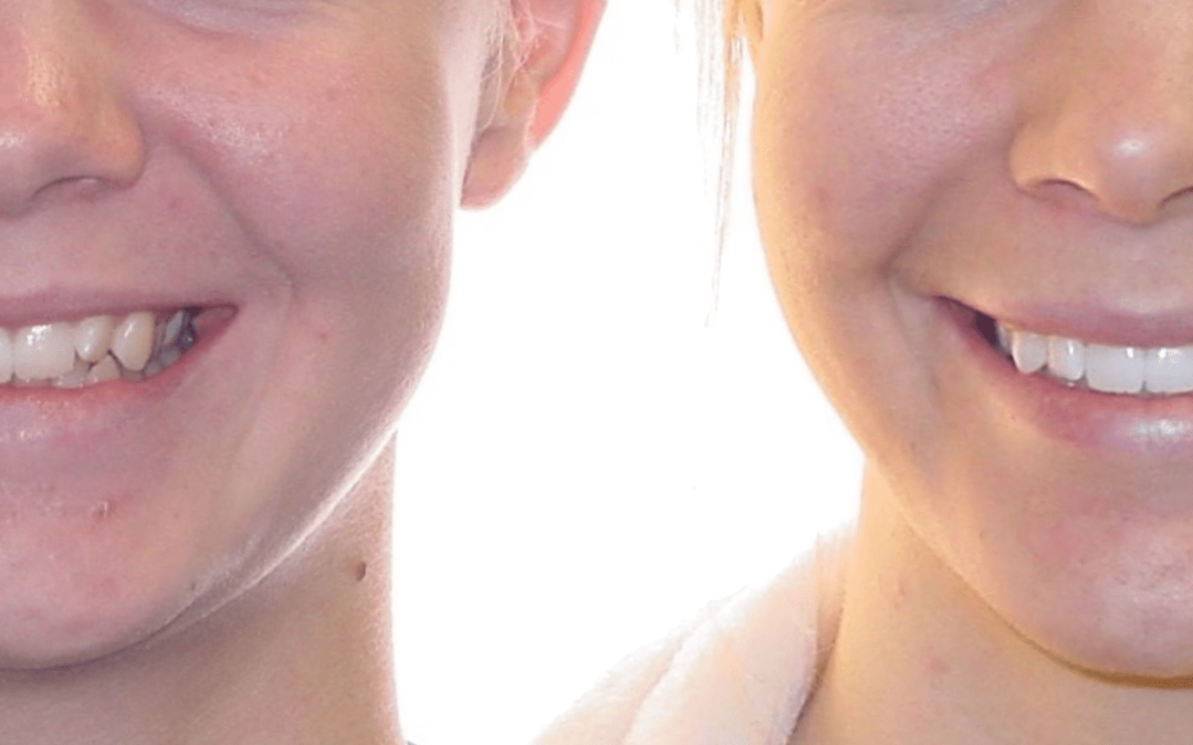 Case Study 17 – Narrow Smiles