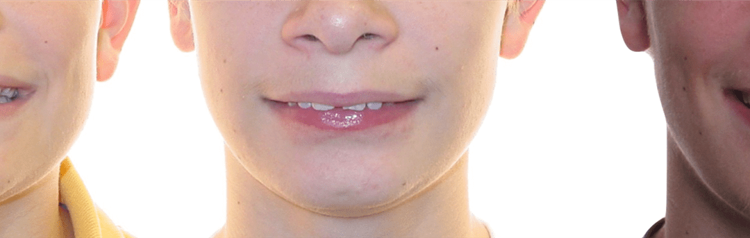 Case Study 6 – Orthodontic Class II