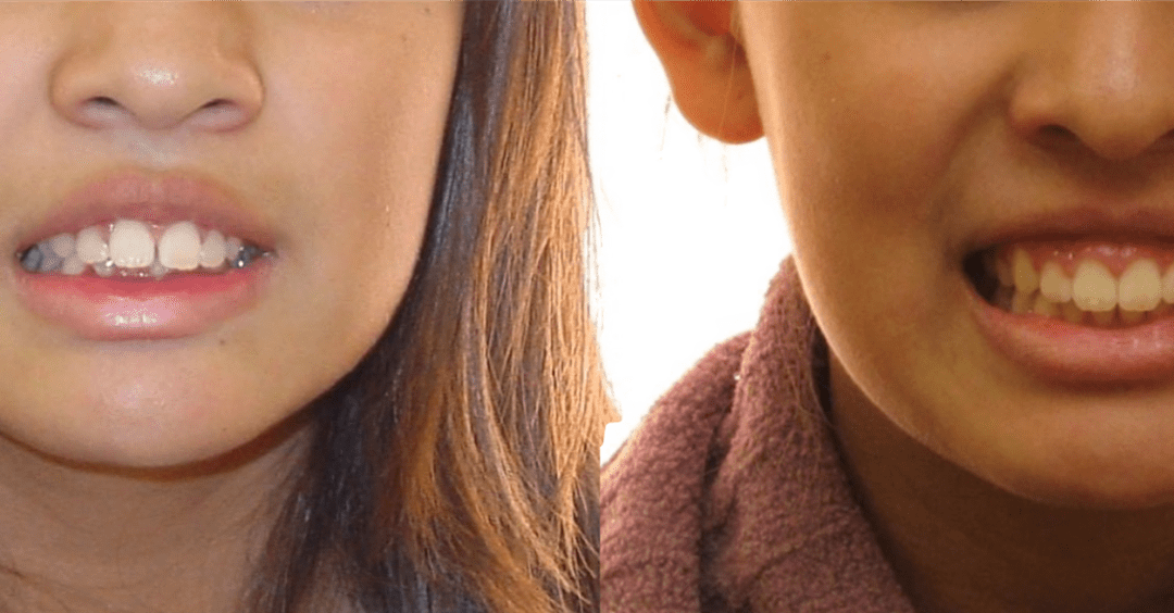 Case Study 2 – Orthodontic Class II