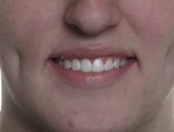 The photo teeth after