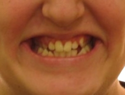 The photo teeth before