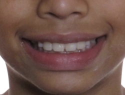 The photo teeth after