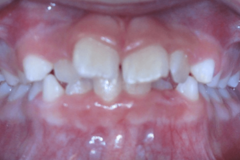 The image of the teeth bite