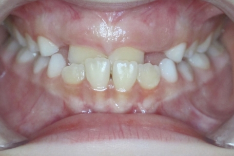 The image of teeth bite