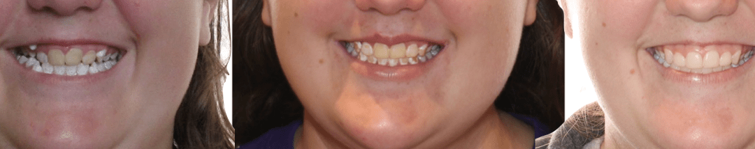 Case Study 59 – Brown Stains on Teeth