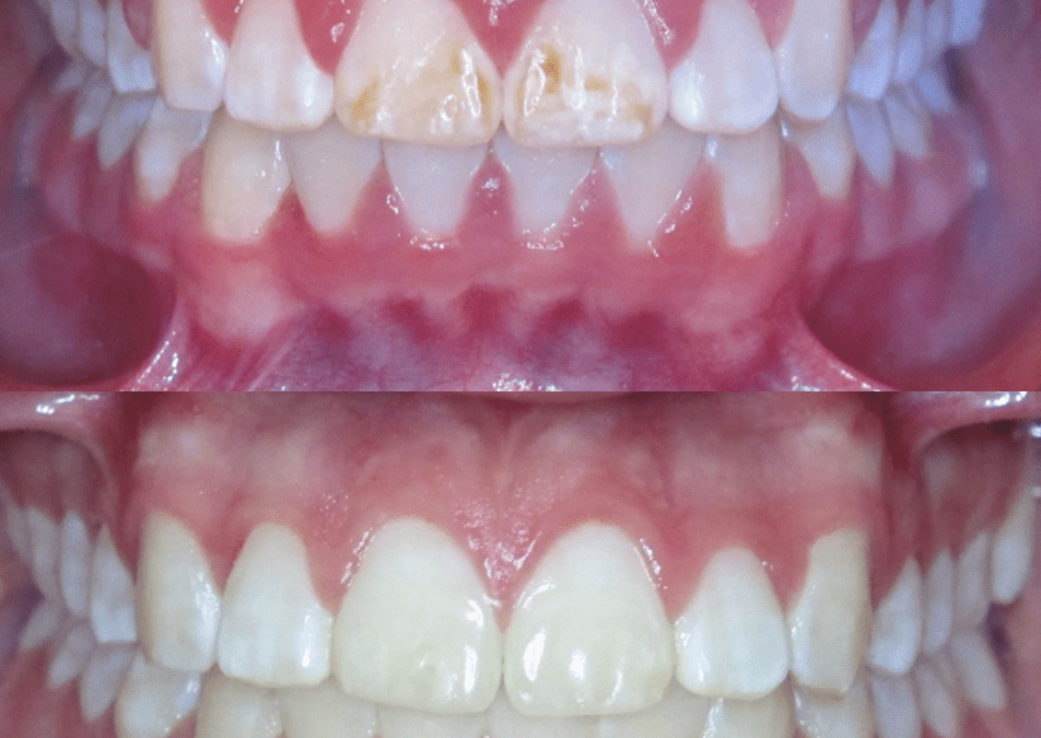 Case Study 61 – Brown Stains on teeth