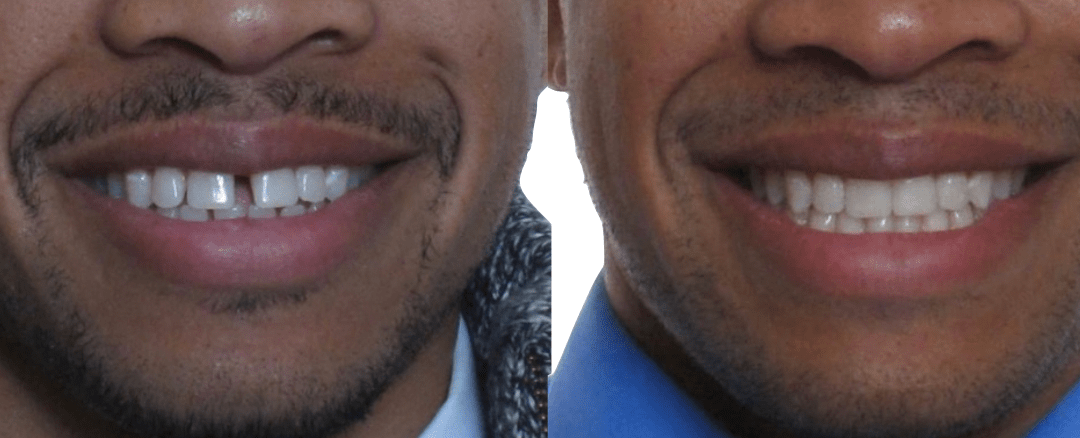 Case Study 67 – Spaces between teeth