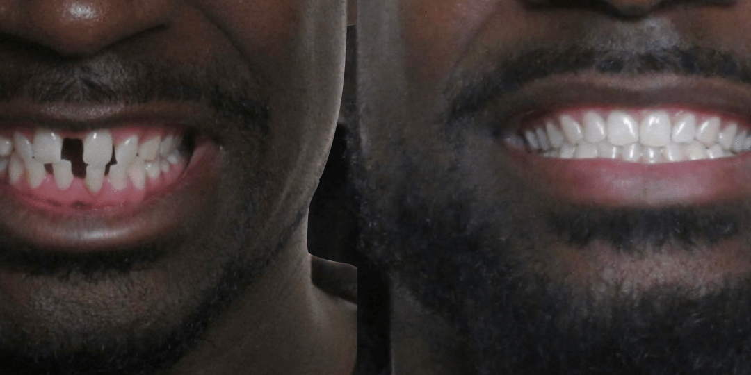 Case Study 68 – Spaces between teeth (Invisalign)