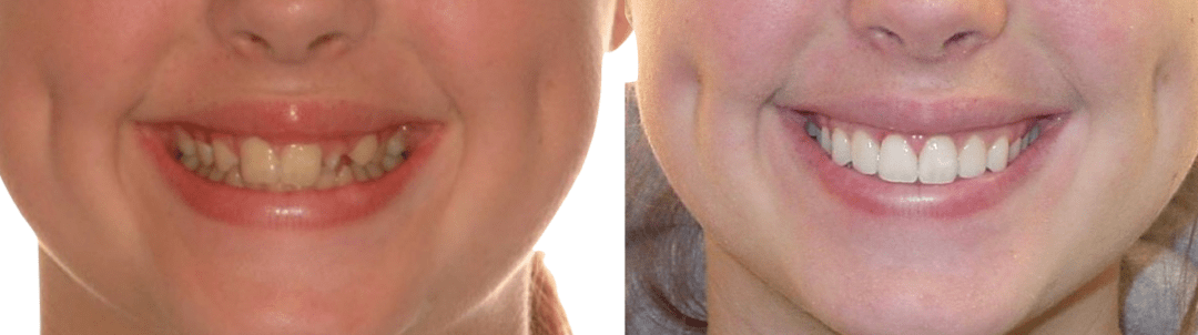 Case Study 77 – Missing upper right lateral incisor, peg upper left lateral incisor, and replaced both with dental implants