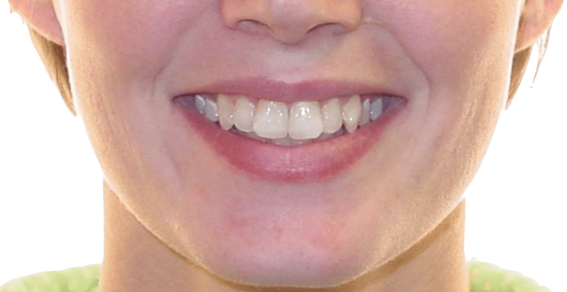 Case Study 84 – Missing a lower right first molar, and camouflaged the absence of both with moving the other teeth forward