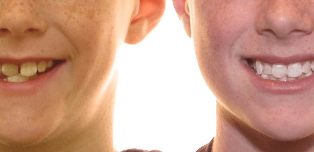 Case Study 43 – Crossbite