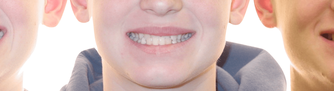 Case Study 48- Crossbite