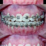 Bandeen Orthodontics Case Study #34