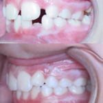 Bandeen Orthodontics Case Study #41