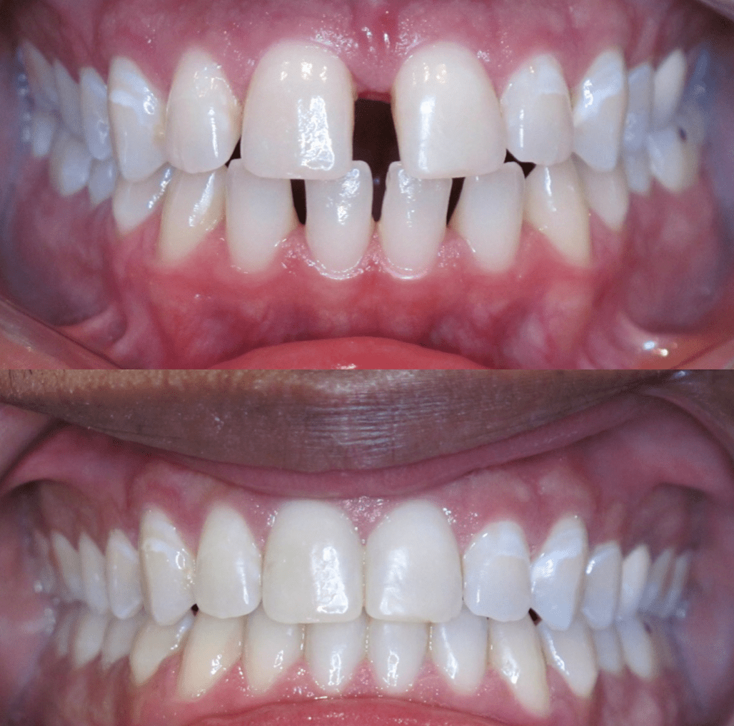 The image of teeth bite