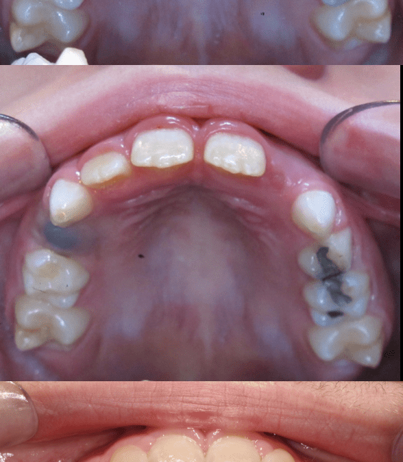 Case Study 42 – Crossbite