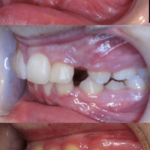 Bandeen Orthodontics Crowding Case 39