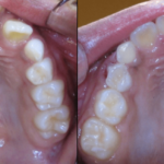 Bandeen Orthodontics Case Study #49