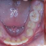 Bandeen Orthodontics Crowding Case 39