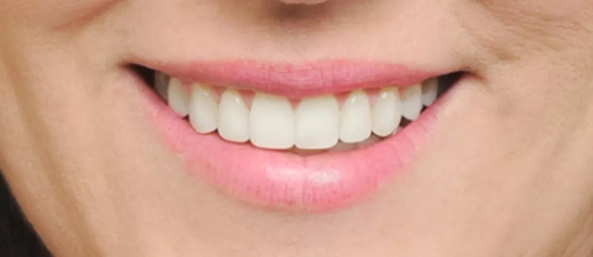 Patient's smile after treatment