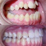 Bandeen Orthodontics Class III Full Treatment Case Studies