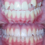 Bandeen Orthodontics Class III Full Treatment Case Studies