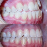 Bandeen Orthodontics Class III Full Treatment Case Studies