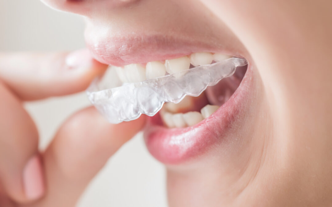 Braces or Invisalign: Which Should I Choose?