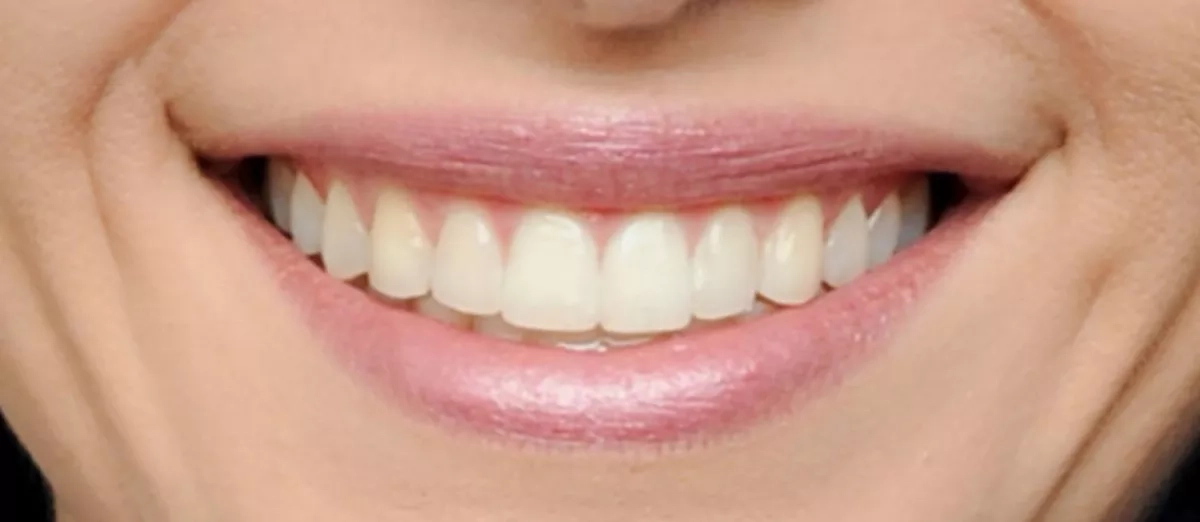 Patient's smile after treatment