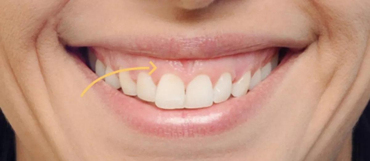 Patient's smile before treatment