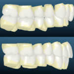 Bandeen Orthodontics Case Studies Ortho Class II