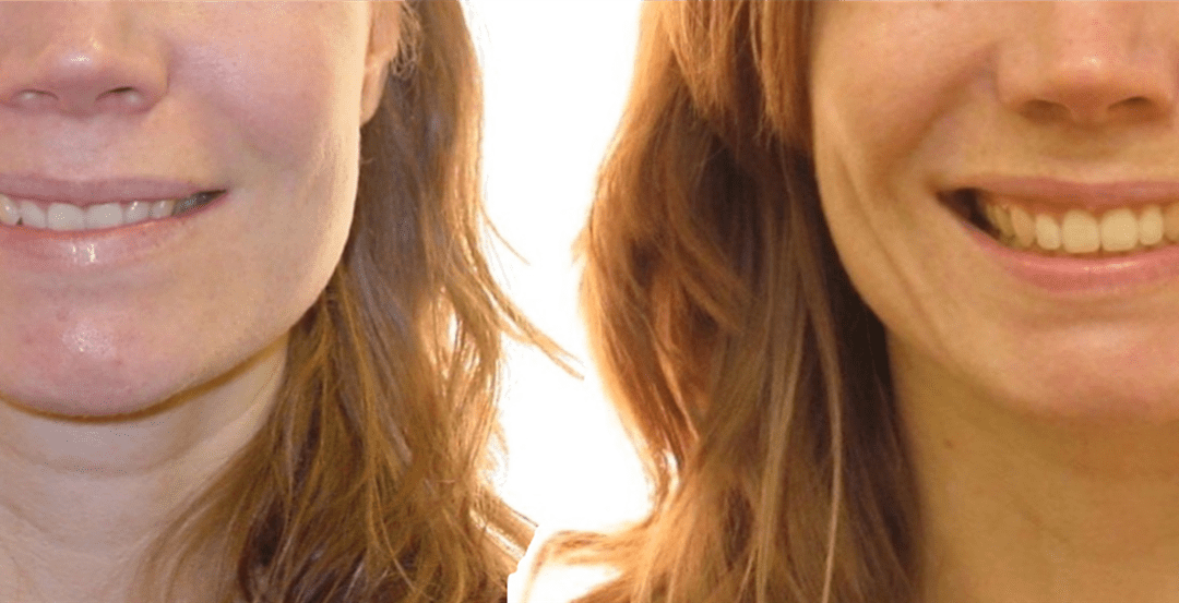 Case Study 1 – Orthodontic Class II