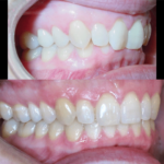 Bandeen Orthodontics Case Studies Ortho Class II