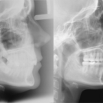 Bandeen Orthodontics Case Studies Ortho Class II