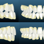 Bandeen Orthodontics Class III Full Treatment Case Studies