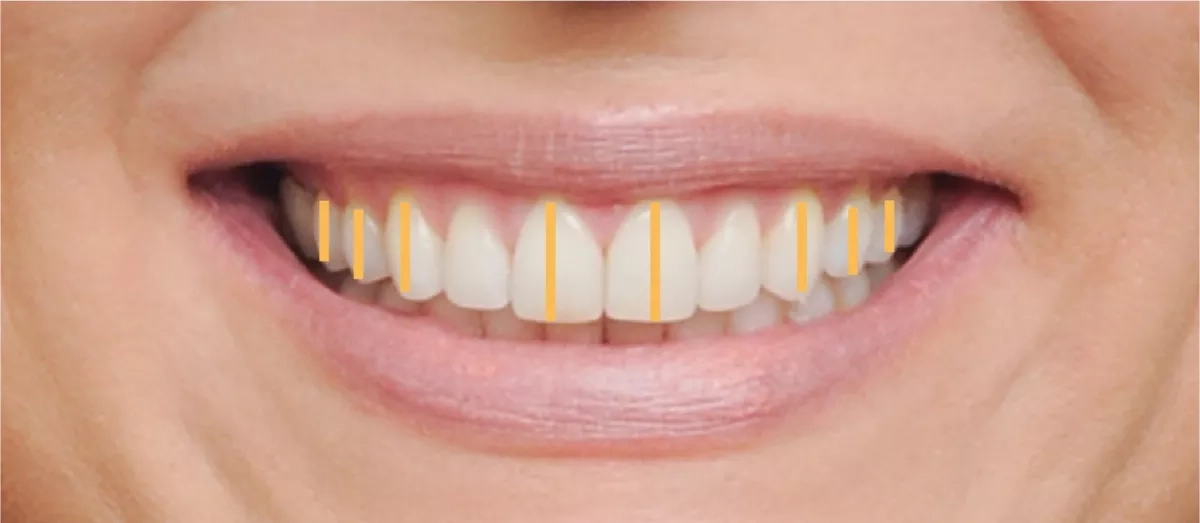 Patient's smile after treatment