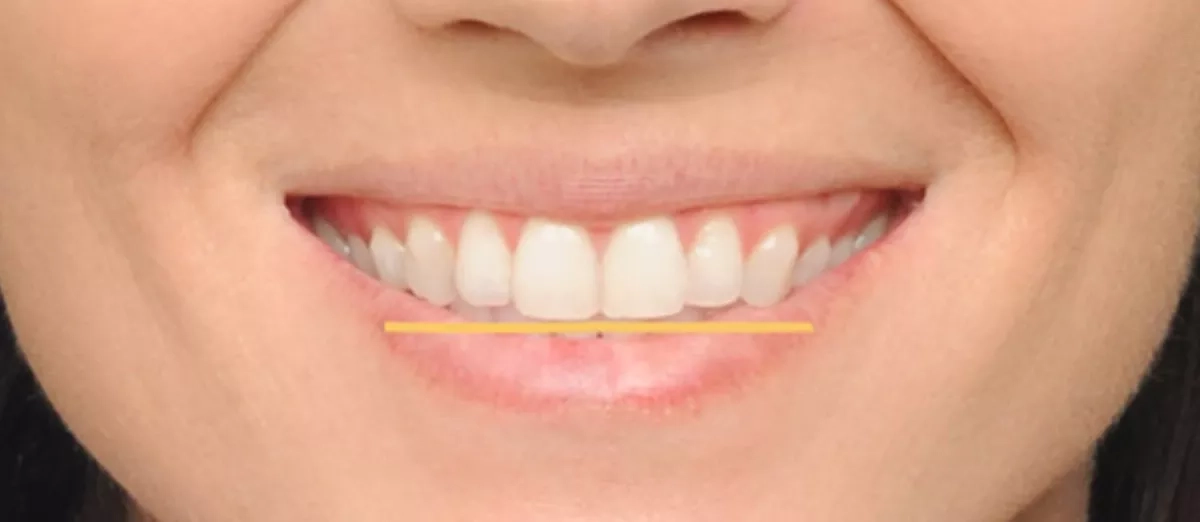 Patient's smile before treatment