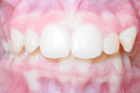 The image of teeth bite