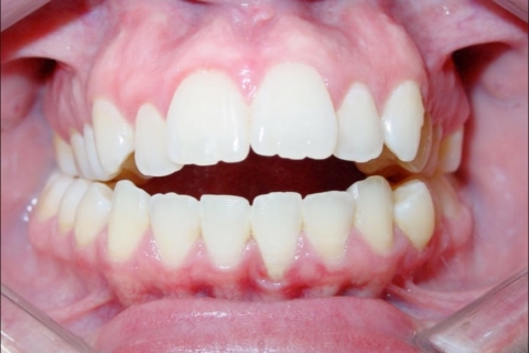 The image of teeth bite